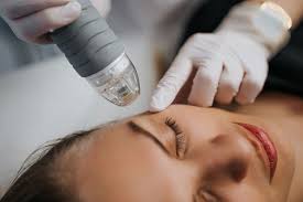 Microneedling (RF)